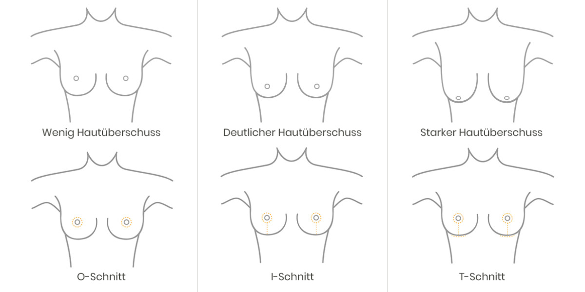 OP-Techniken einer Bruststraffung 